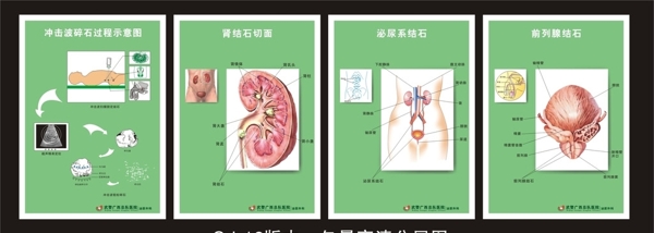 医院结石海报图片