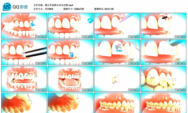 展示牙齿矫正术全过程