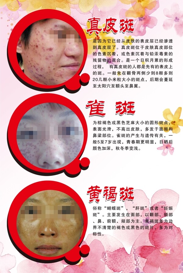 美容去斑真皮斑雀斑黄褐斑